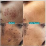 pilgrim 10% niacinamide face serum with 1% zinc pca for acne marks 30ml